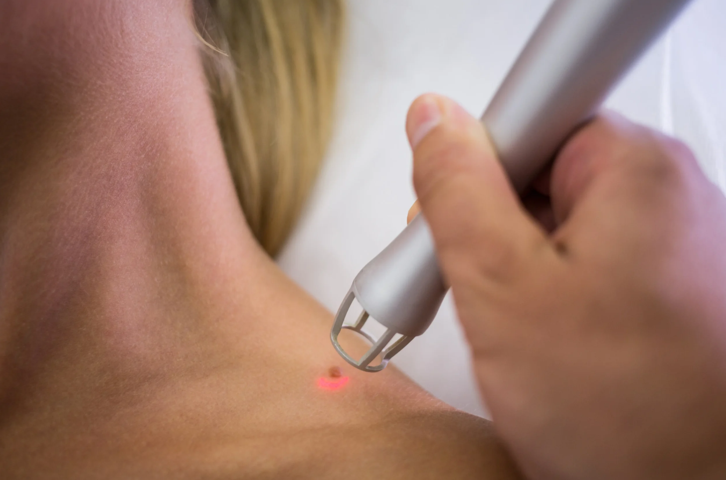Laser Wart Removal: Safe and Effective Treatment Options